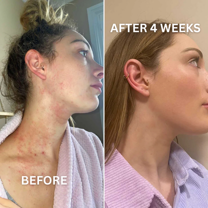 Eczema Relief Gummies