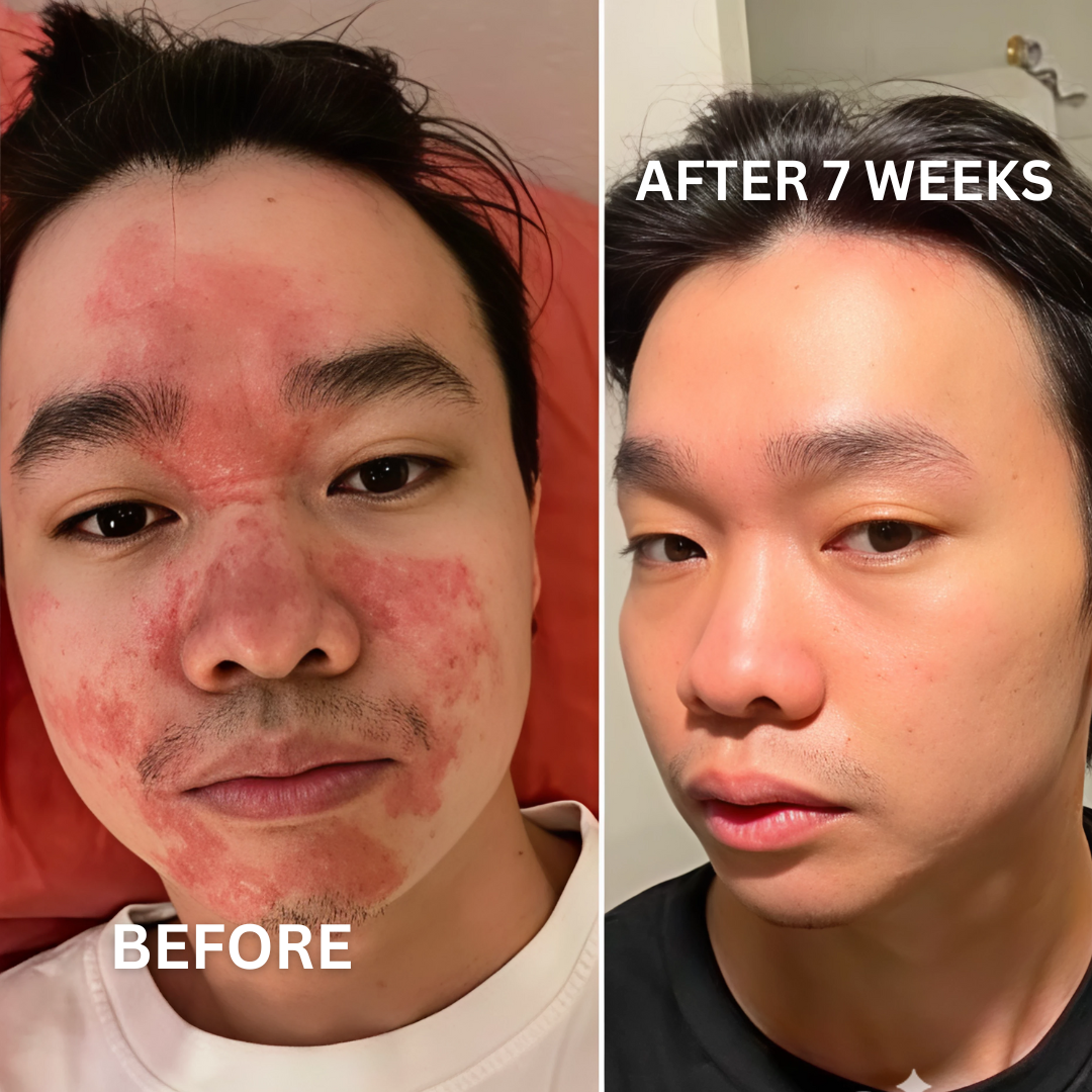 Eczema Relief Gummies