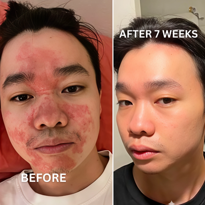 Eczema Relief Gummies