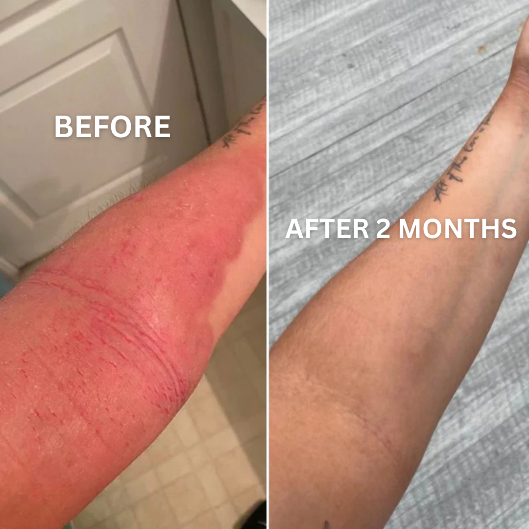 Eczema Relief Gummies